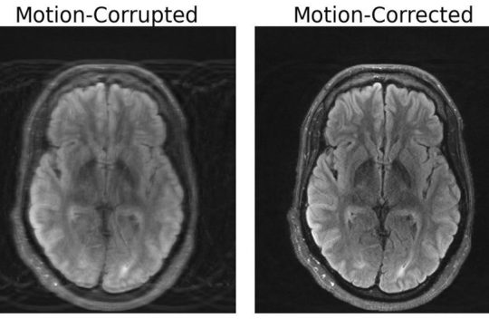 Two side-by-side images of an MRI that has been motion-corrupted and one that has been motion-corrected
