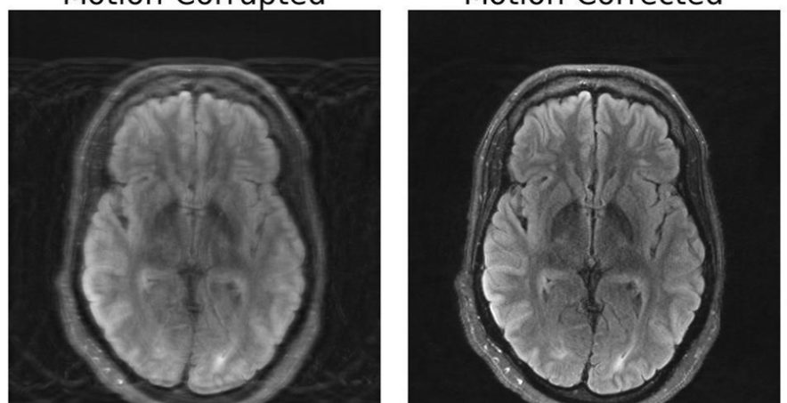 Two side-by-side images of an MRI that has been motion-corrupted and one that has been motion-corrected